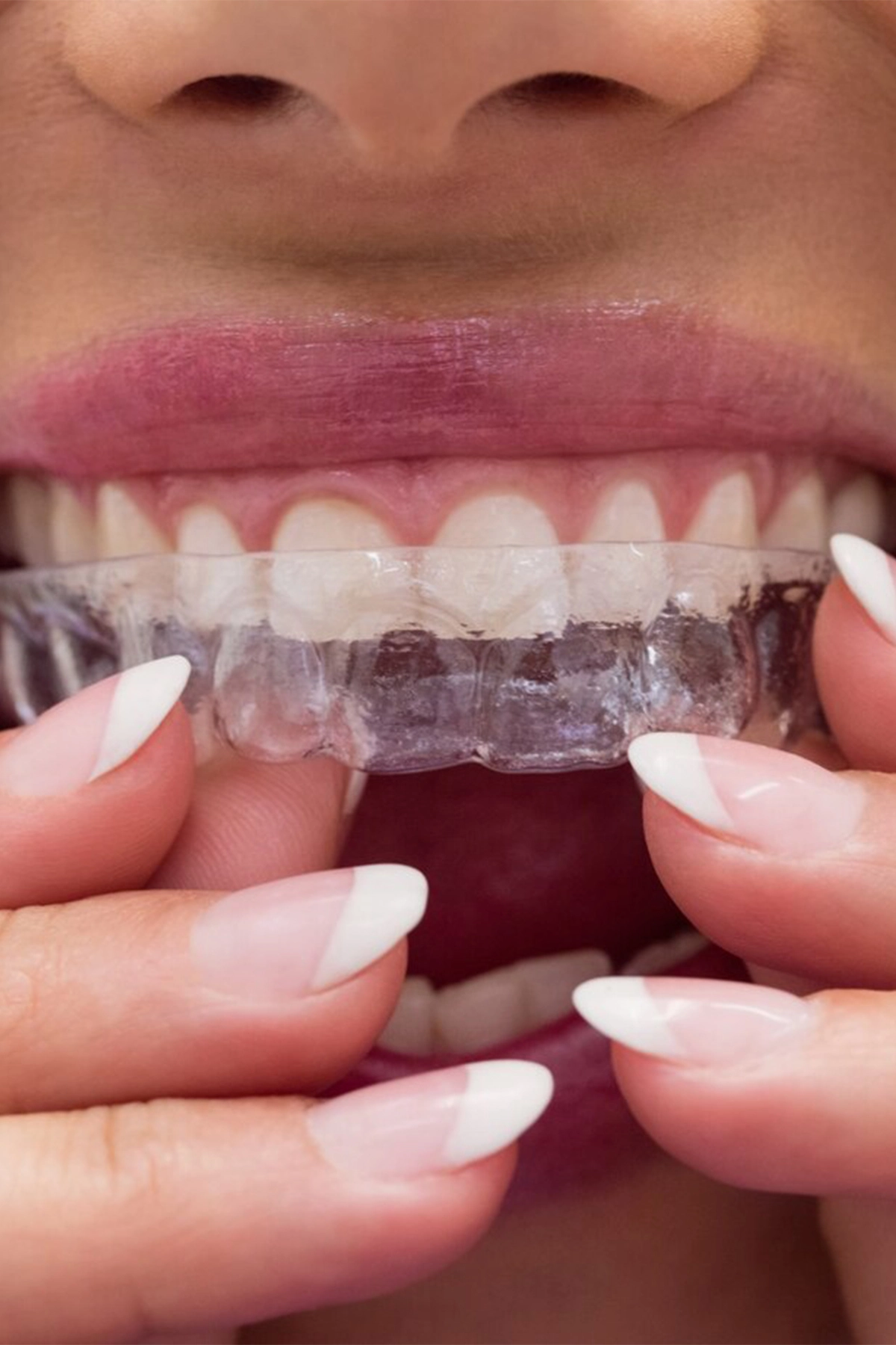 https://www.studiodentisticoassociatosimonelli.it/wp-content/uploads/2024/04/invisalign-dentista-alessandria-1.webp